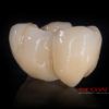 Crowns – implanty – all in one – most cyrkon – 4840-2015 72dpi
