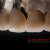 Crowns – implanty – most cementowany cocr – 7353-2015 -72dpi